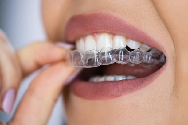 close-up shot of a woman's mouth while wearing her Invisalign