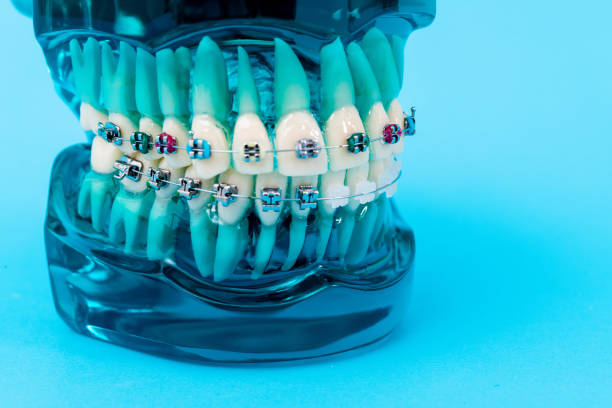 a dental model with colorful braces