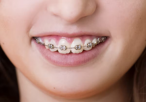close-up shot of teeth with braces