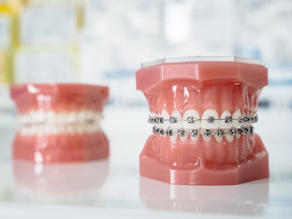 a dental model with metal braces