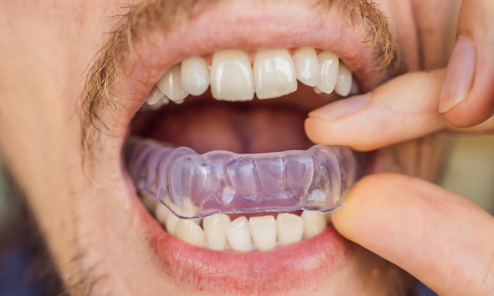Close-up of a person placing a clear nightguard over their teeth to help protect against teeth grinding during sleep.