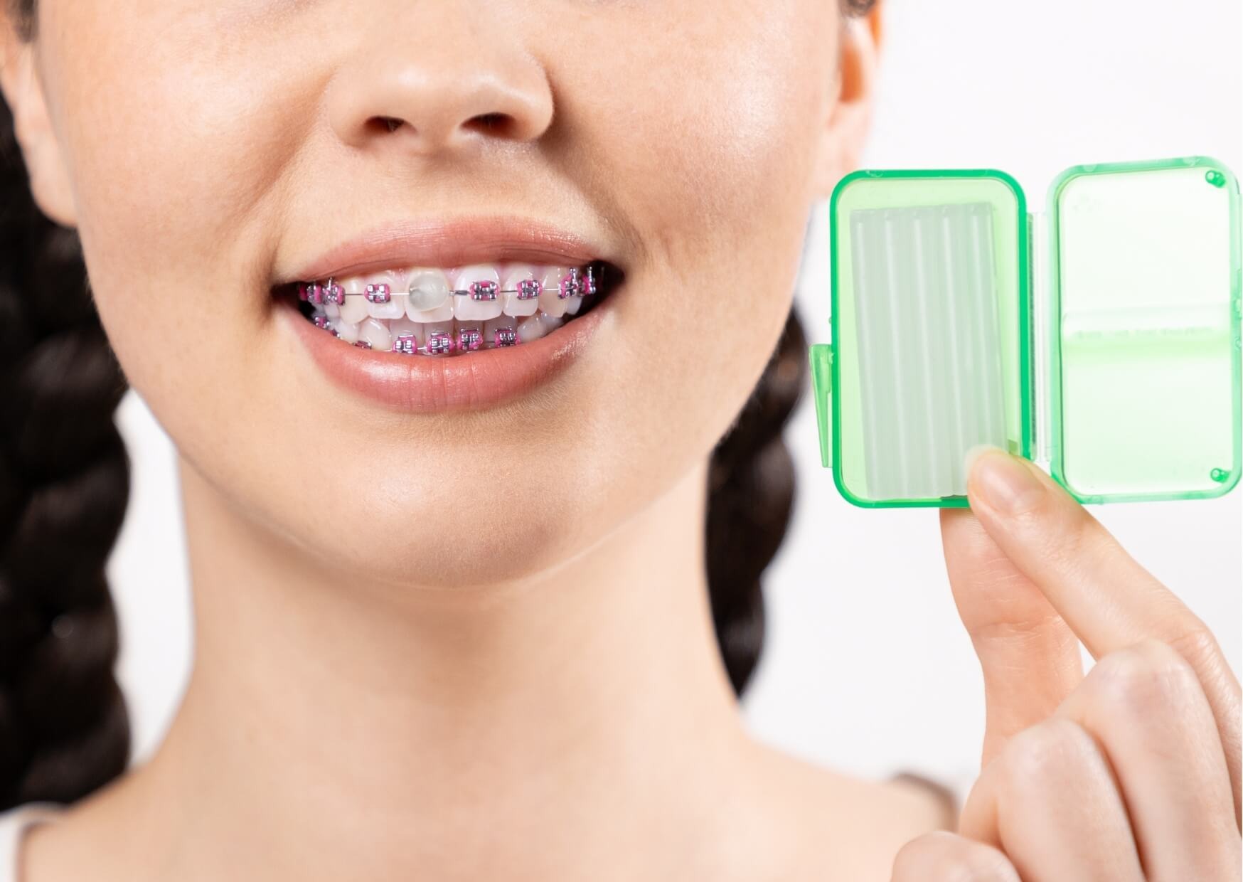 Close-up of braces with orthodontic wax applied to reduce discomfort and protect the inside of the mouth