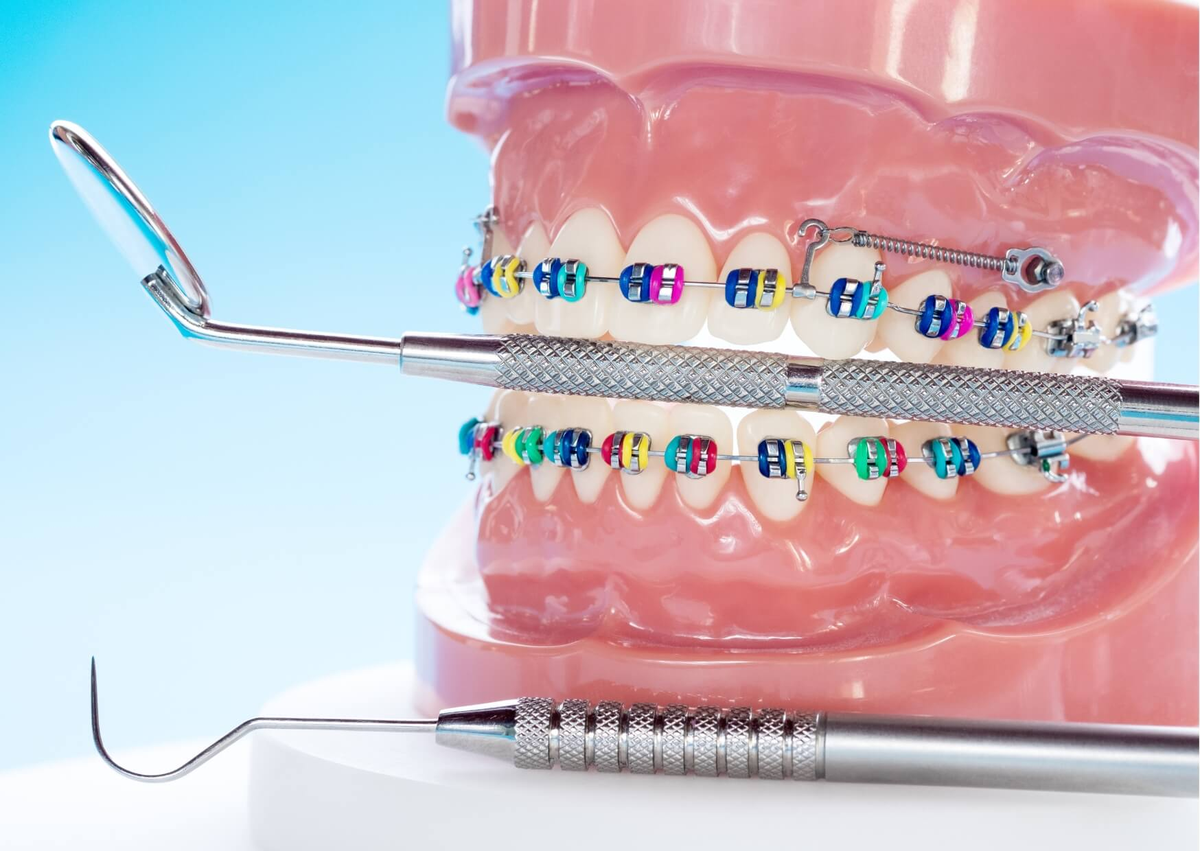 Orthodontic model with braces demonstrating how braces can correct an overbite by gradually improving tooth and jaw alignment.