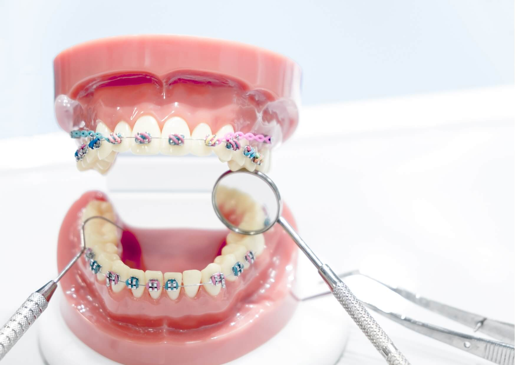 Dental model with braces demonstrating how braces can gradually correct an underbite by improving tooth alignment and bite position.