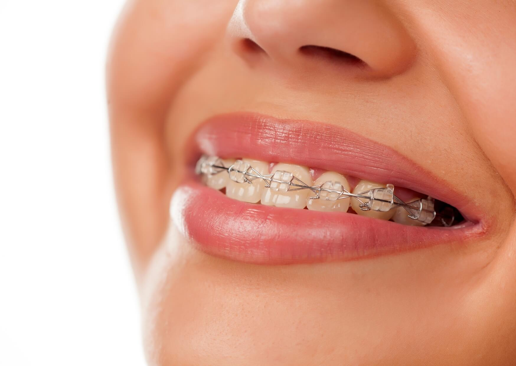 Close-up of clear ceramic braces on teeth, showing a discreet orthodontic option for patients considering whether clear braces are worth it.
