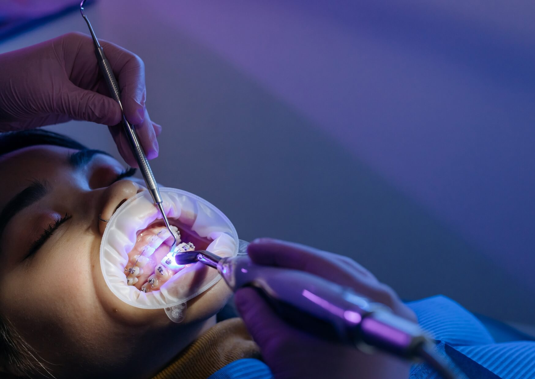 Orthodontist adjusting Damon braces during a routine appointment to monitor tooth movement and treatment progress.