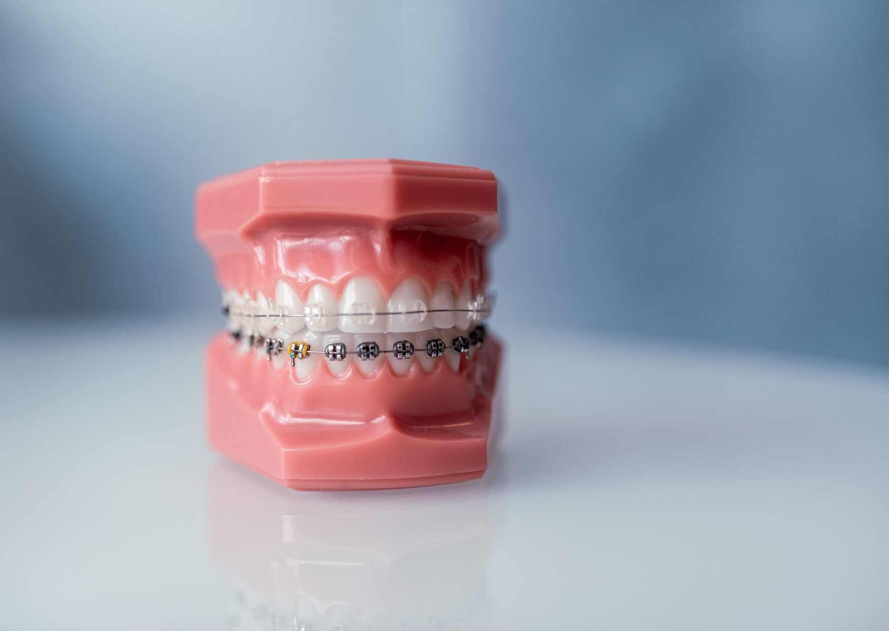 Dental model showing clear ceramic braces and traditional metal braces for comparison.
