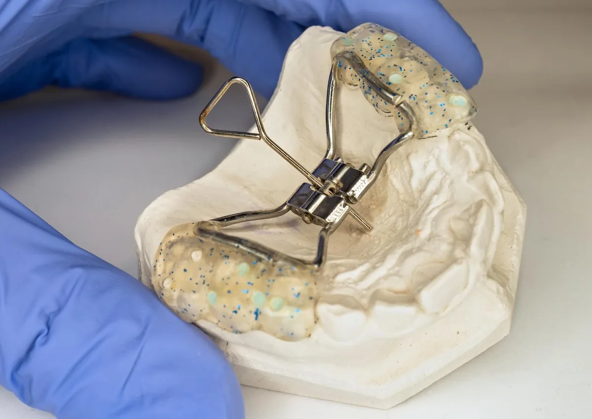 Palatal expander on a dental model showing an orthodontic appliance used before braces to create more space.