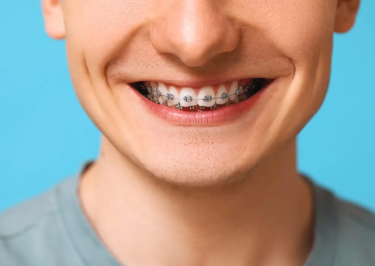 Close-up of braces used to fix an overbite by gradually improving tooth and bite alignment.