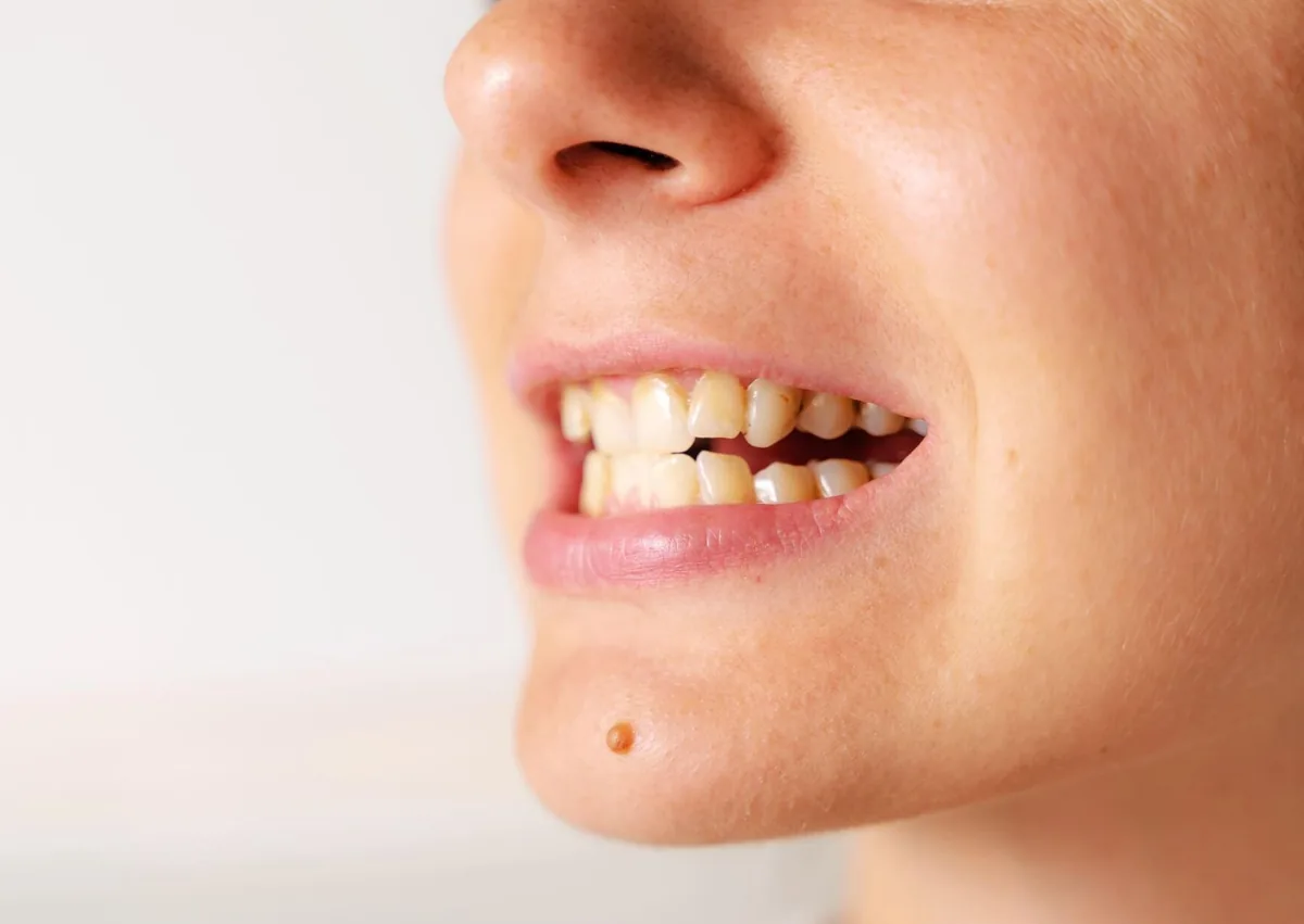 Close-up of an open bite showing a gap between the upper and lower front teeth before correction.