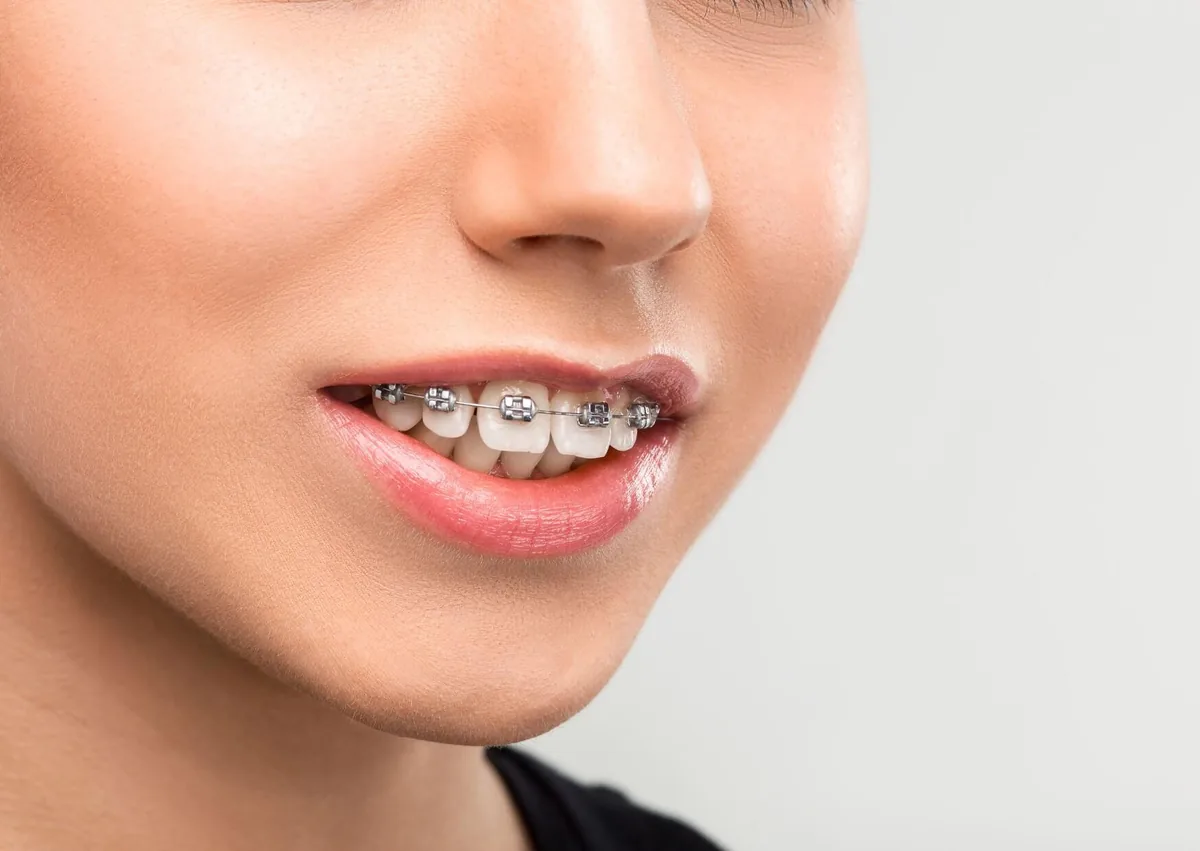 Close-up of braces used to gradually correct an overbite and improve tooth alignment.