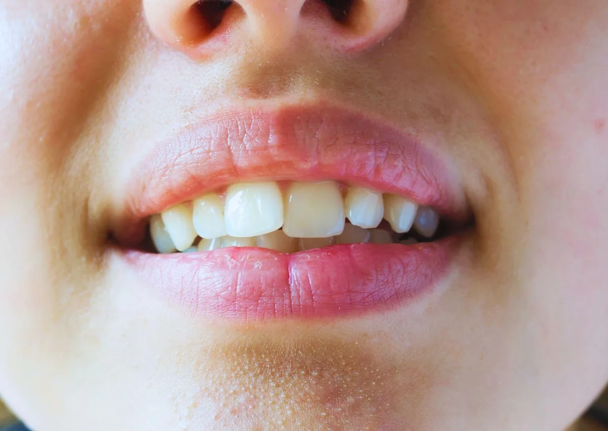 Close-up of teeth shifting out of alignment after orthodontic braces treatment.